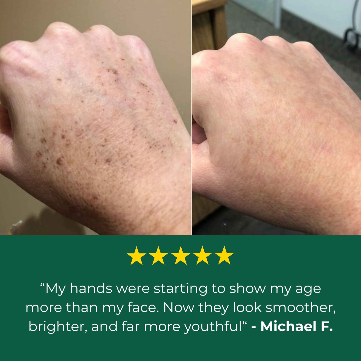 Duromet Age Spot Cream