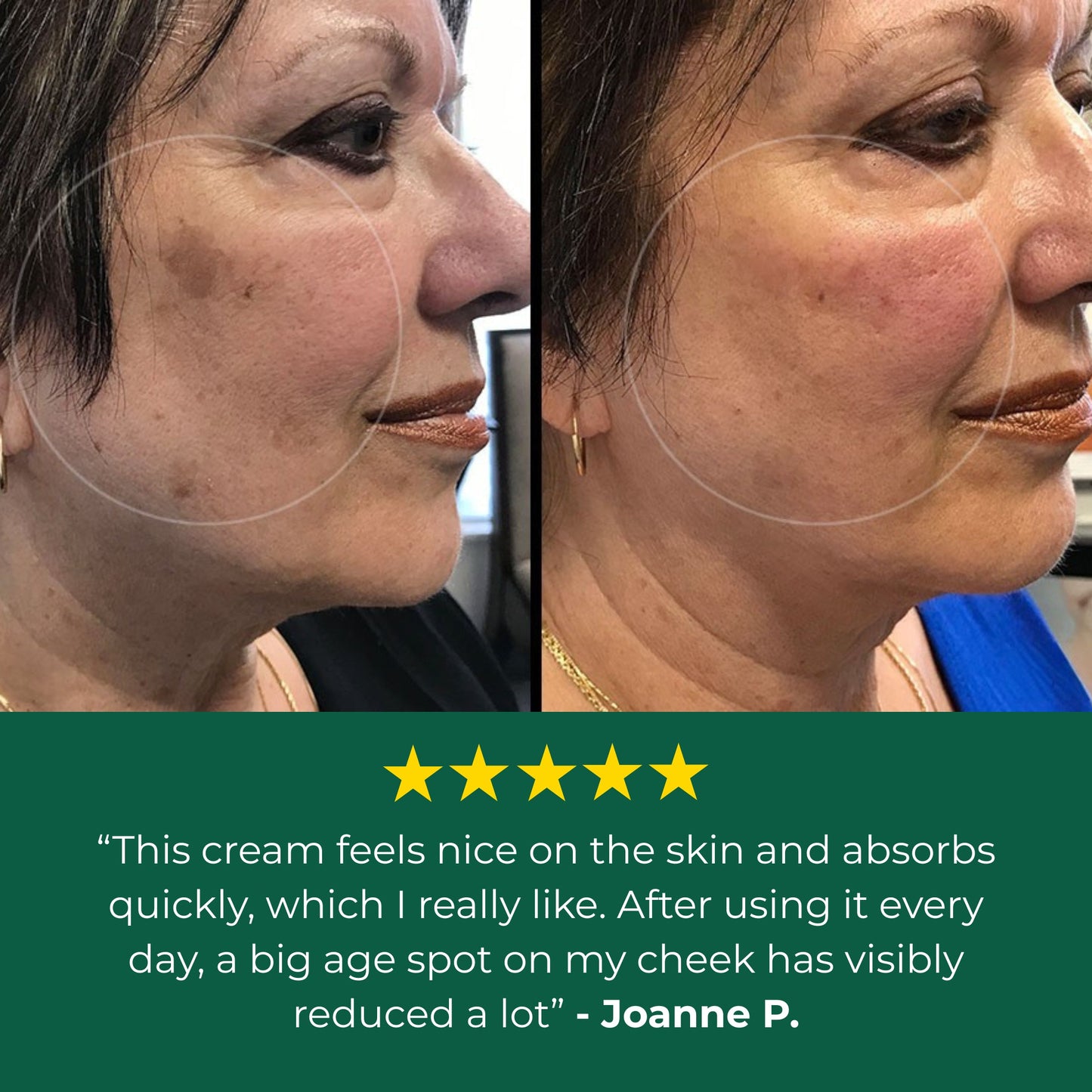 Duromet Age Spot Cream
